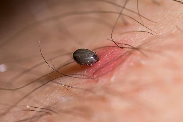The covers of the tick's body are soft, and therefore it is very dangerous to squeeze a saturated parasite because of the risk of squeezing out the already infected blood and saliva into the wound.