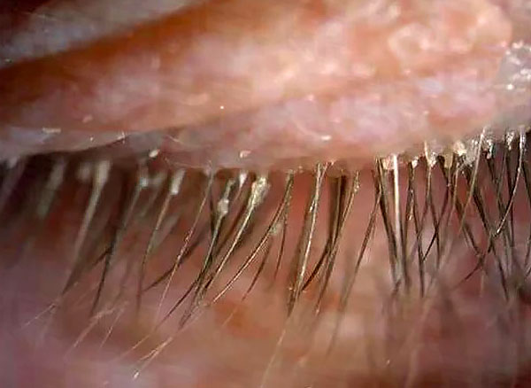 A characteristic symptom of demodicosis is a discharge on the eyelashes.