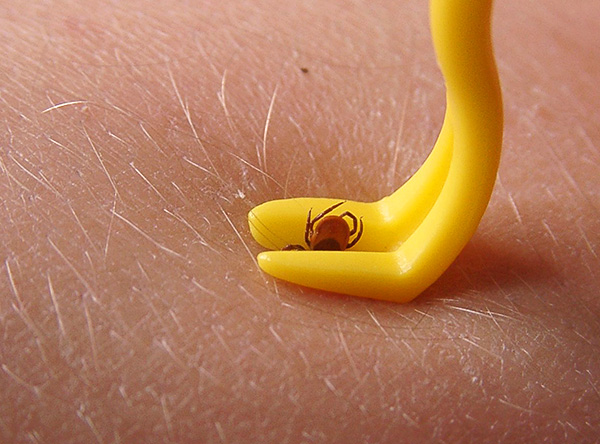 The photo shows an example of extracting the tick from the skin using a special extractor.