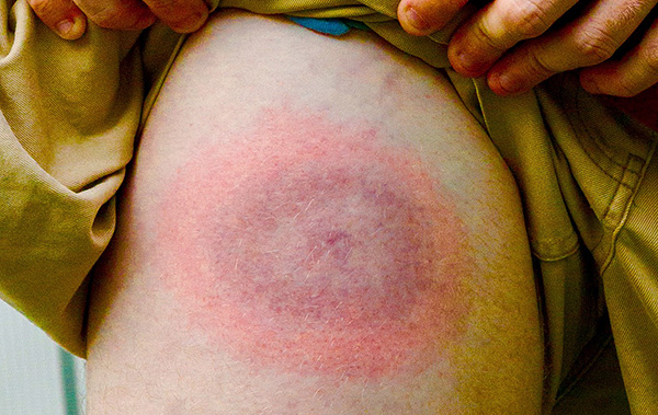 Ring erythema migrans is a sign of tick-borne borreliosis infection.