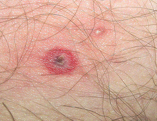 Rödhet och klåda på platsen för en fästbett är inte några tecken på infektion.