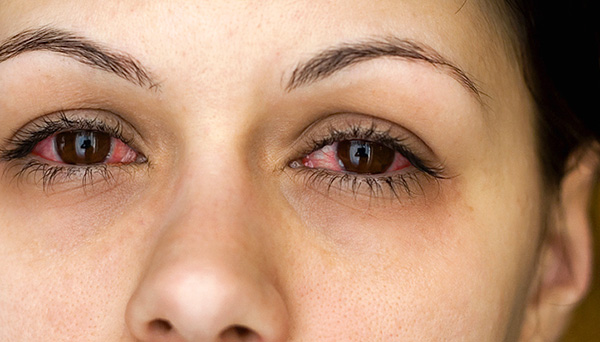 Rhinoconjunctivitis can occur against the background of dust mites in the house.