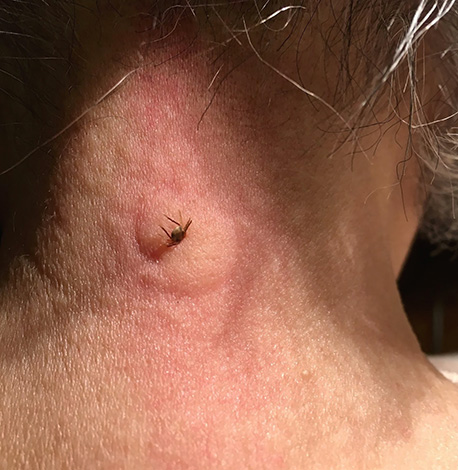 In some cases, a severe allergic reaction develops to the tick bite.