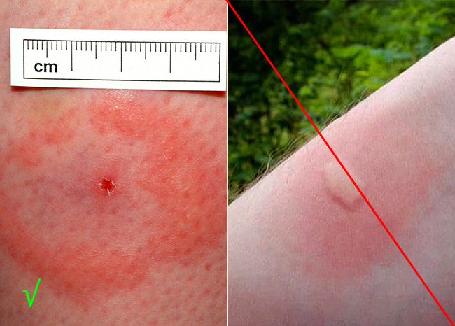 Vlevo je stopa kousnutí klíštěte, vpravo od kousnutí komára.