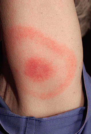 Αυτό είναι το εμφάνιση του ερυθήματος του δακτύλου - ένα σημάδι της λοίμωξης από τη βορρέλιο του Lyme.