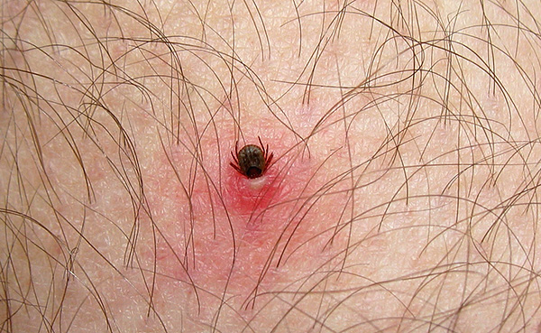 Když pohryz, parazit může ponořit hlavu do kůže do značné hloubky.